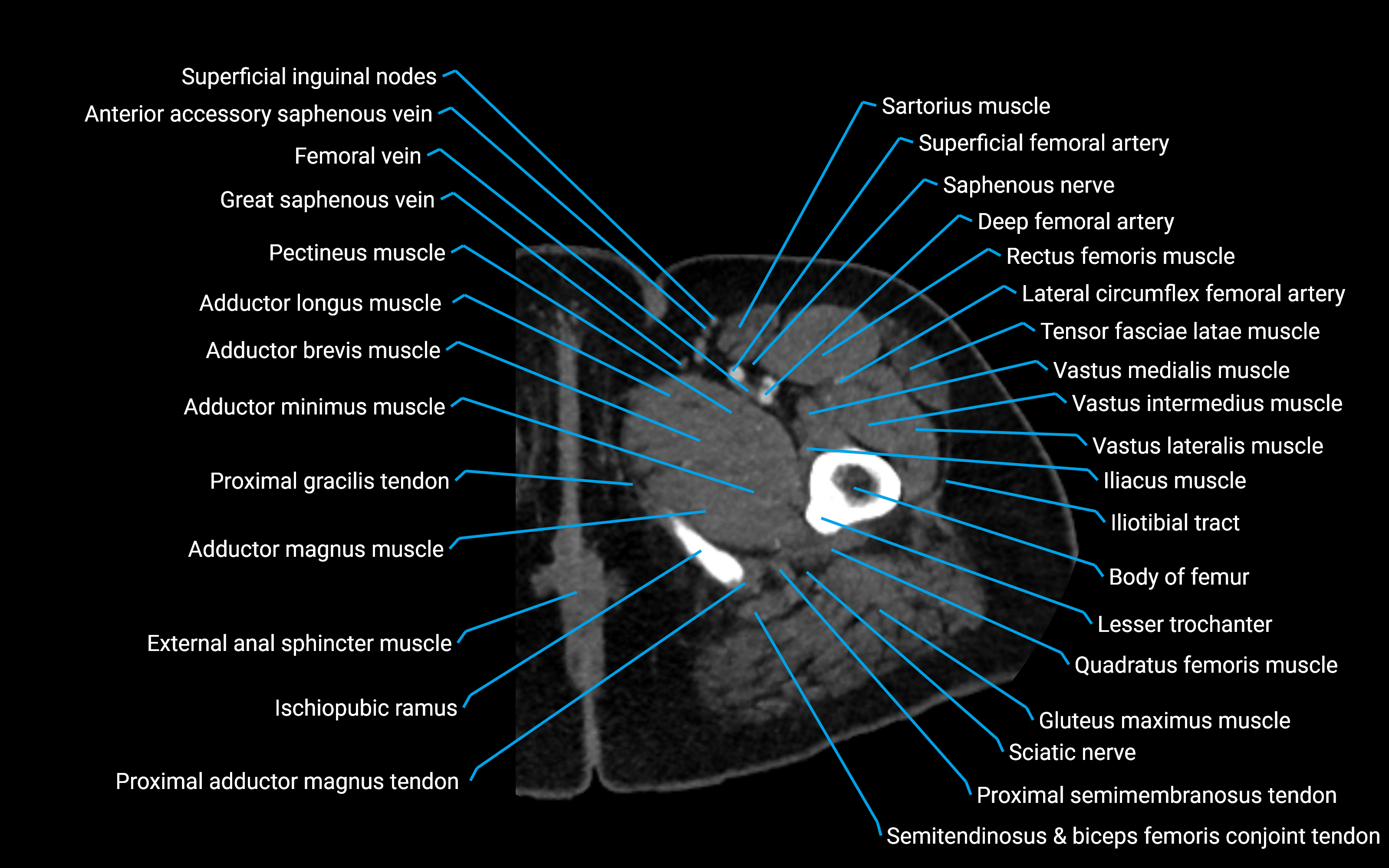 CT Hip axial cross sectional anatomy labelled image 19 (2).png